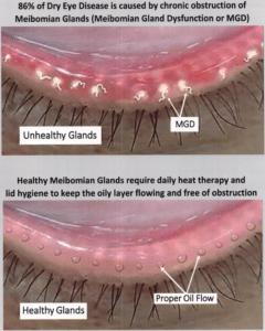 Thermal Therapy For Dry Eye MGD In Seattle Cannon EyeCare Thermal Therapy For Dry Eye MGD In Seattle Cannon EyeCare