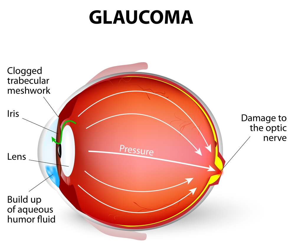 Glaucoma Evaluation and Management