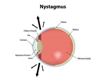 Nystagmus