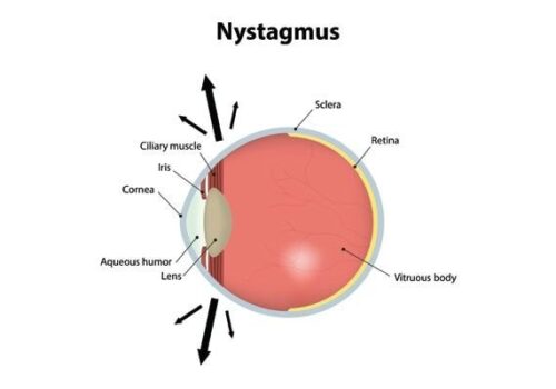 Nystagmus