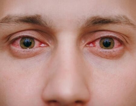 Conjunctivitis