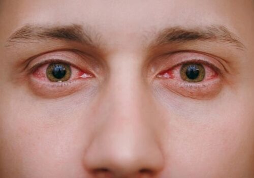 Conjunctivitis