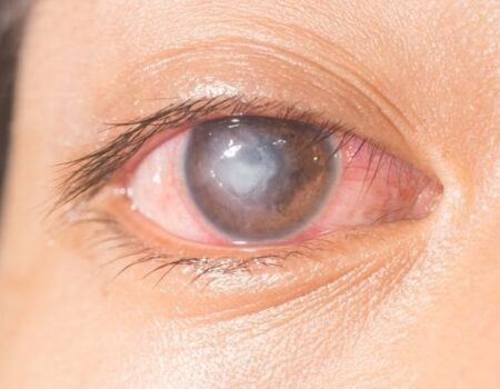 Corneal Ulcer