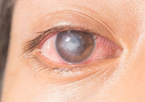 Corneal Ulcer