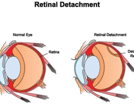 Detached Retina