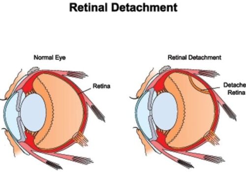 Detached Retina