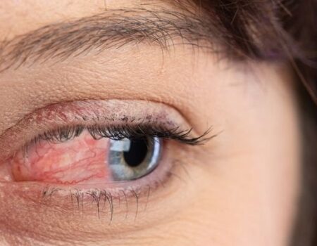 Ocular Rosacea