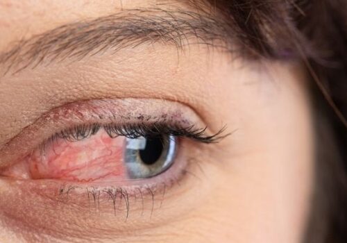 Ocular Rosacea