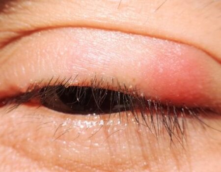 Blepharitis