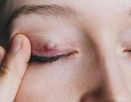 Chalazion