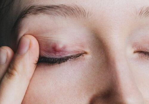 Chalazion