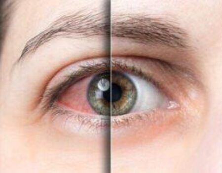 Dry Eye Disease