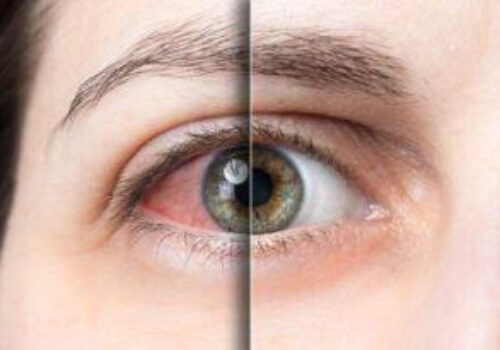 Dry Eye Disease