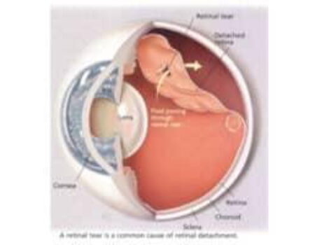 Retinal Detachment