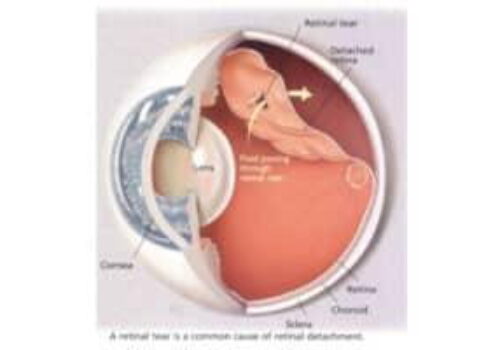 Retinal Detachment