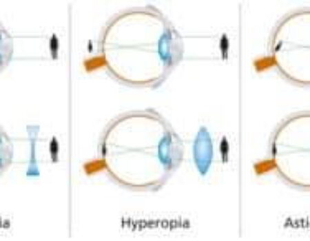 What is Astigmatism?