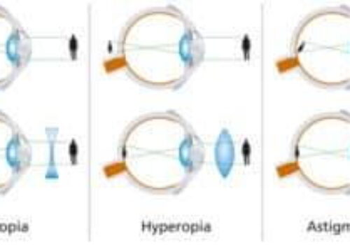 What is Astigmatism?