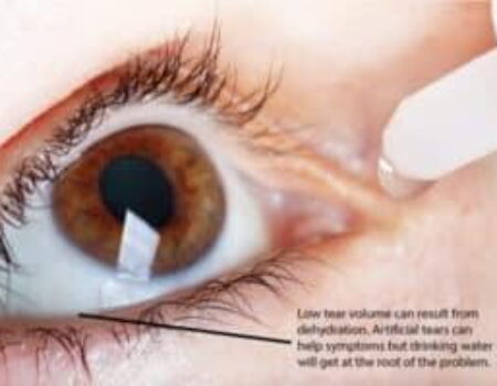 Dry Eye Syndrome