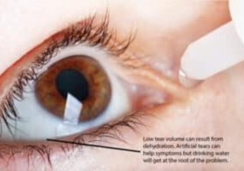 Dry Eye Syndrome