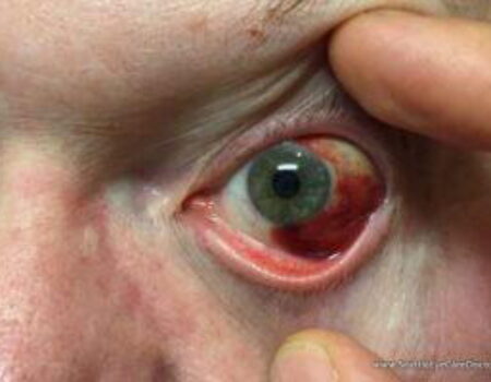 Do you have Pink Eye?