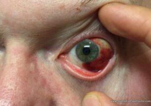 Do you have Pink Eye?