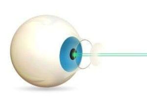 Laser Cataract Surgery