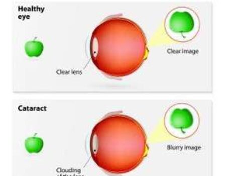 Cataract Surgery