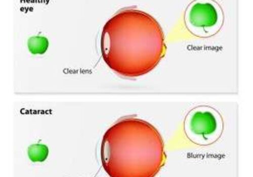 Cataract Surgery