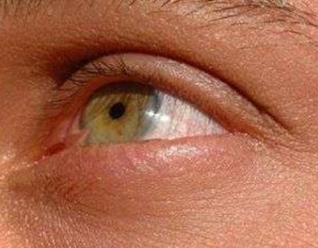 Pterygium