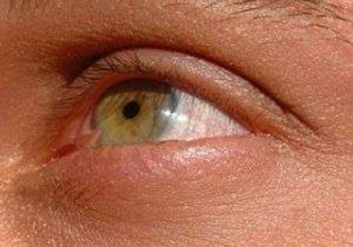 Pterygium