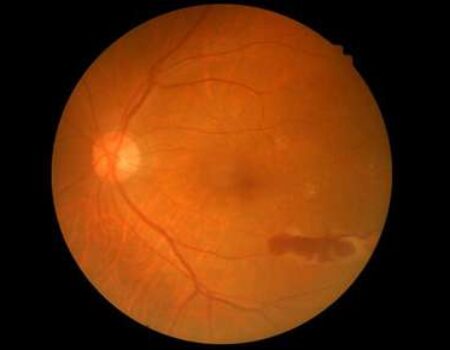 Diabetic Eye Diseases