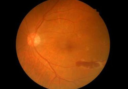 Diabetic Eye Diseases