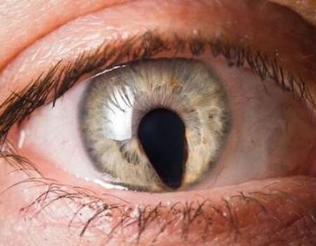 Iridocorneal Endothelial Syndrome