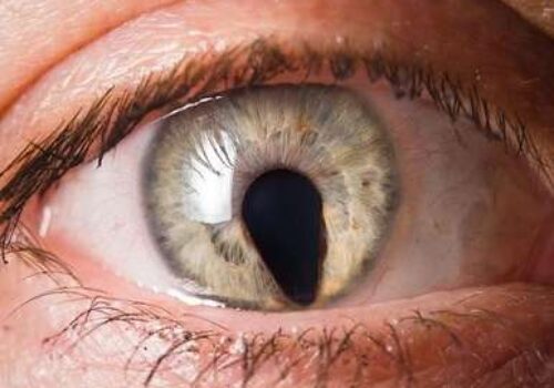 Iridocorneal Endothelial Syndrome