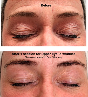 After1Tixel-Lift+Face