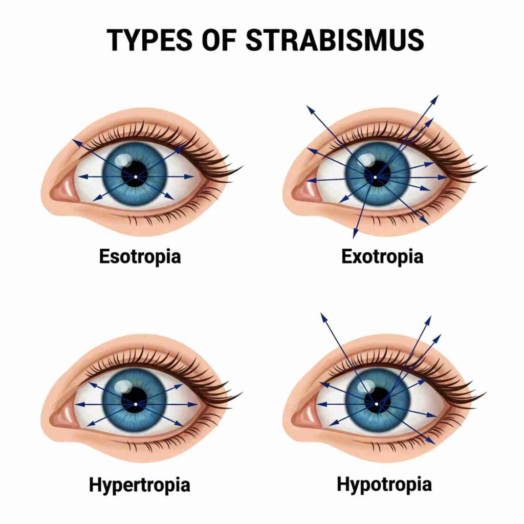 Illustration showing types of strabismus: esotropia, exotropia, hypertropia, and hypotropia.