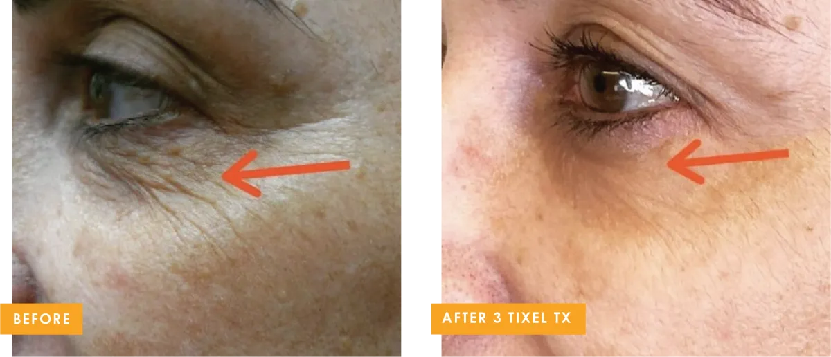 Tixel dry eye treatment