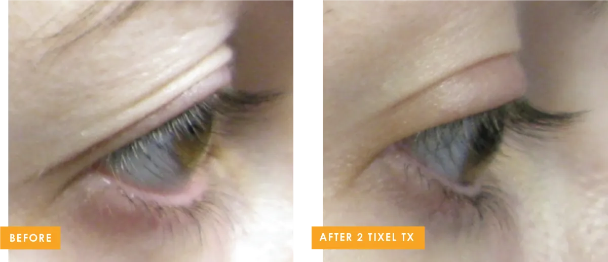 Tixel-UpperLids-B4+after-2Tx