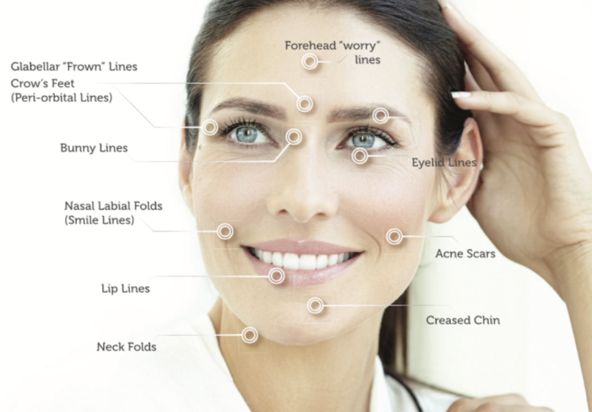 Tixel dry eye treatment