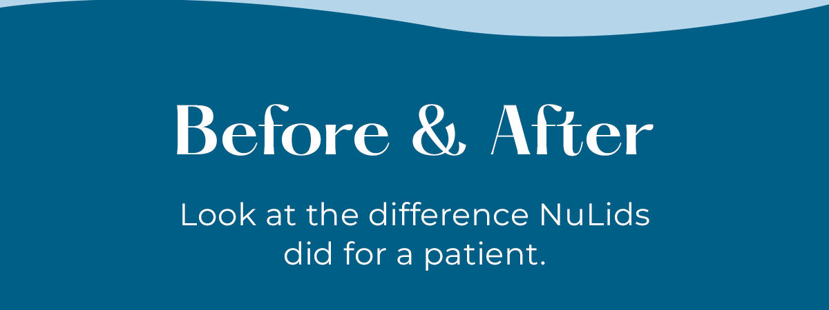 NuLids-Demodex-Before&After (1)